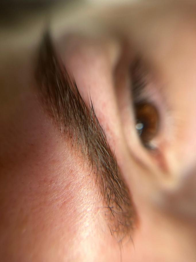Brow Lifting